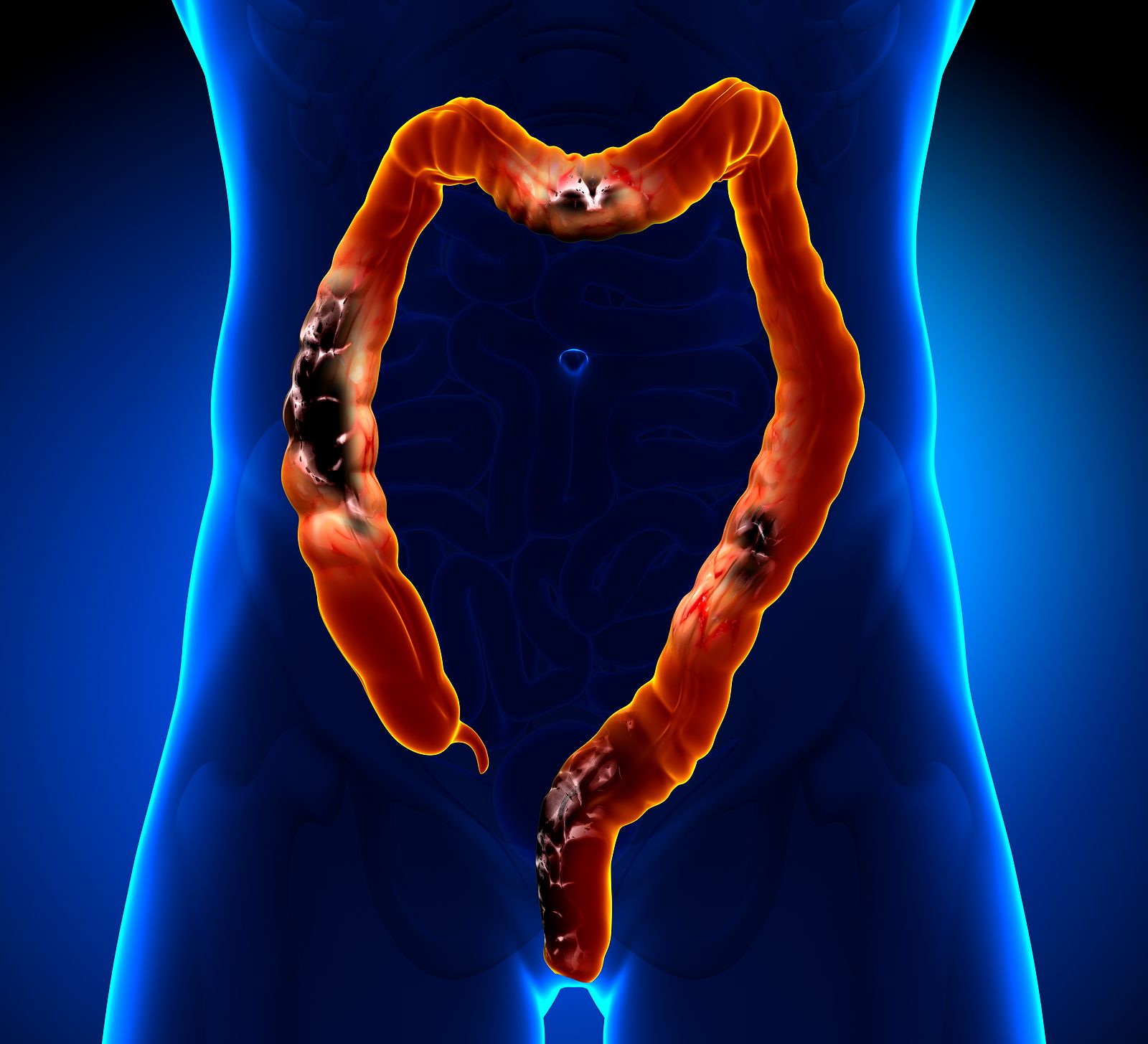 bigstock Colon CancerColorectal canc 59883752