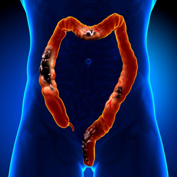 bigstock Colon CancerColorectal canc 59883752 bigstock Colon CancerColorectal canc 59883752