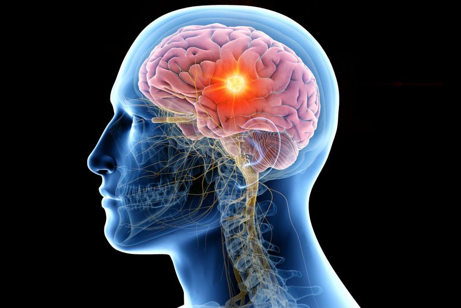 Estimulación Cerebral Profunda Estimulación Cerebral Profunda