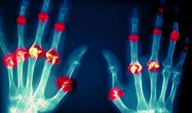 La medicina regenerativa puede ser la clave para curar la artritis reumatoide: todos los detalles