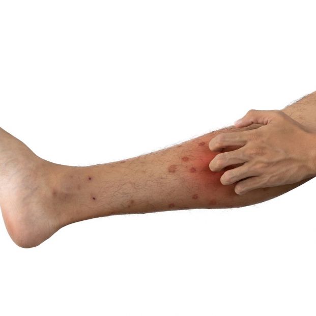 Picor en las piernas Picor en las piernas