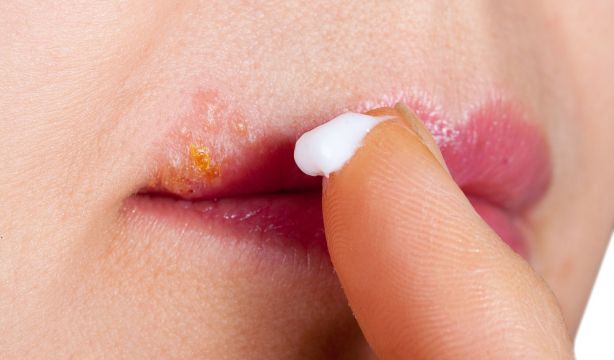 El herpes labial podría estar implicado en el desarrollo del alzhéimer. Bigstock