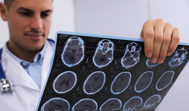 El retraso medio del diagnóstico de la esclerosis múltiple en España es de dos años (Bigstock()