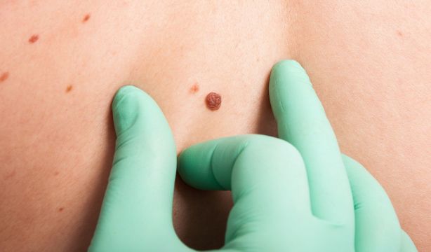 Nueva terapia que combate el melanoma resistente a los tratamientos. (Bigstock)