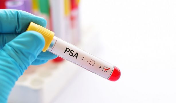 Cáncer de próstata: expertos alertan sobre quién realmente necesita la prueba de PSA