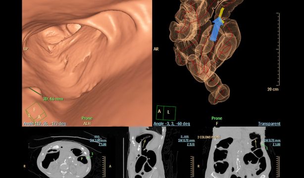 La colonoscopia virtual supera a la prueba de heces para la detección del cáncer de colon. (Bigsock)