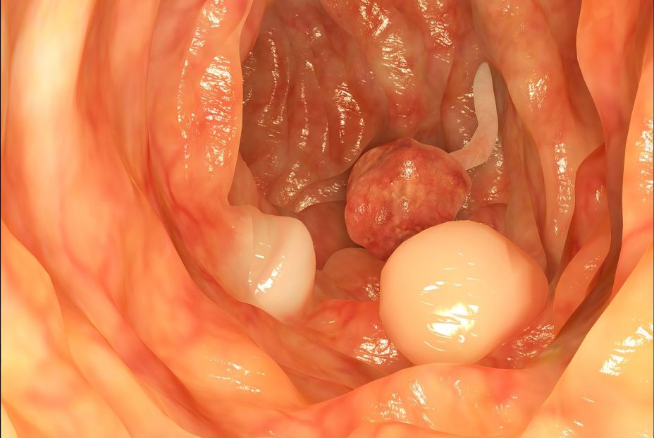 Imagen de pólipos en el colon. (Bigstock)