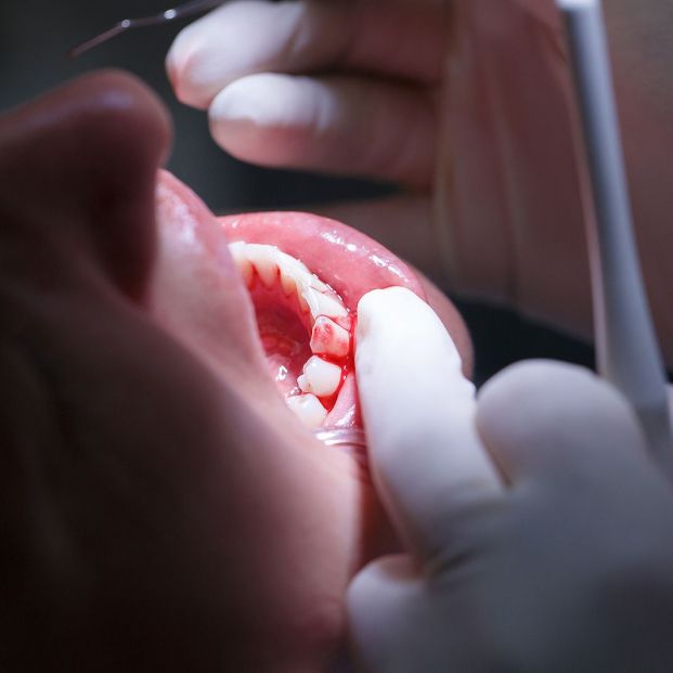 El 'nuevo combo' que reduce la gravedad de la periodontitis. (Bigstock) El 'nuevo combo' que reduce la gravedad de la periodontitis. (Bigstock)