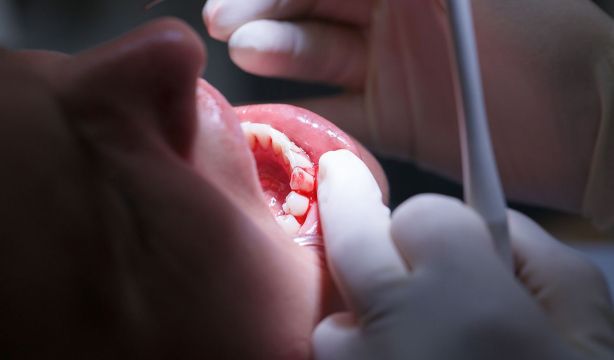 El 'nuevo combo' que reduce la gravedad de la periodontitis. (Bigstock)