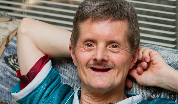 El alzhéimer comienza 15 años antes del inicio de los síntomas en personas con síndrome de Down