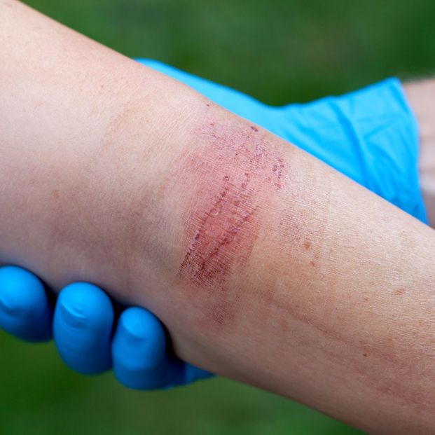 bigstock Burned Skin 71551414