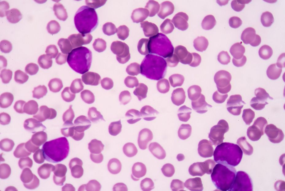 bigstock Acute Myeloblastic Leukemia am 96205286