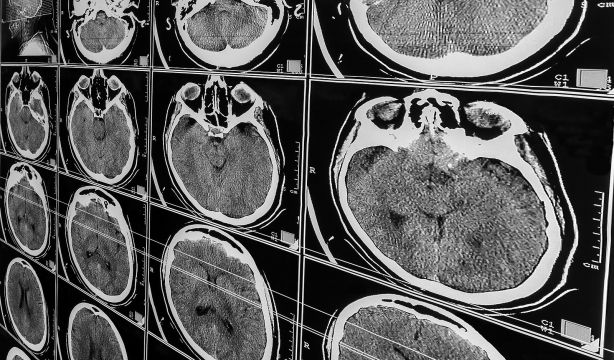 El CSIC participa en la obtención de la escala de riesgo genético de Alzheimer más completa hasta la fecha