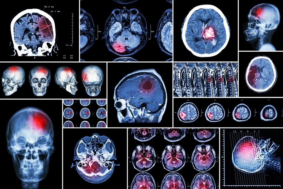 bigstock SetCollection Of Brain Dise 106060739