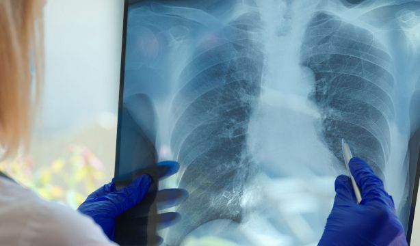 La fibrosis pulmonar idiopática, una enfermedad incurable