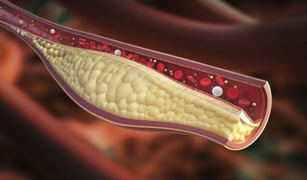Investigadores españoles descubren una nueva vía para combatir la aterosclerosis