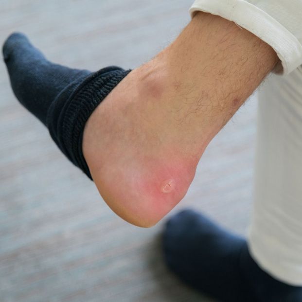 Aprende a explotar una ampolla correctamente Aprende a explotar una ampolla correctamente