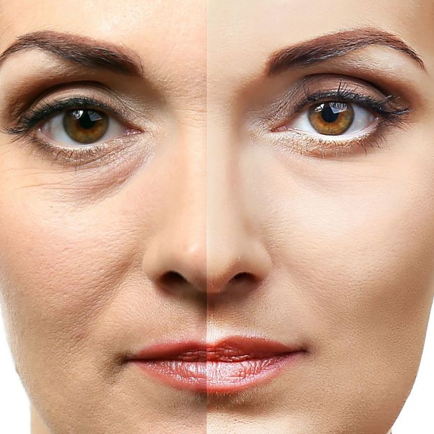 Blefaroplastia o cirugía de párpados, en qué consiste (Bigstock) Blefaroplastia o cirugía de párpados, en qué consiste (Bigstock)