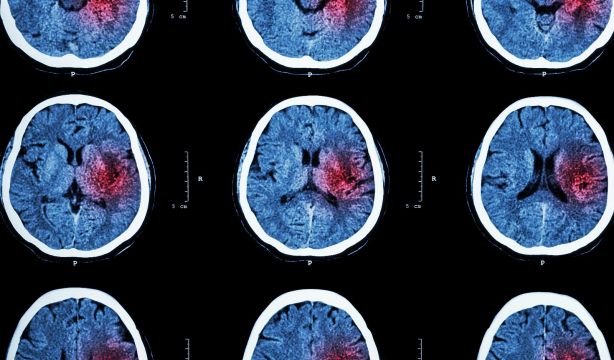 Una nueva calculadora de riesgo puede predecir mejor el ictus (Bigstock)