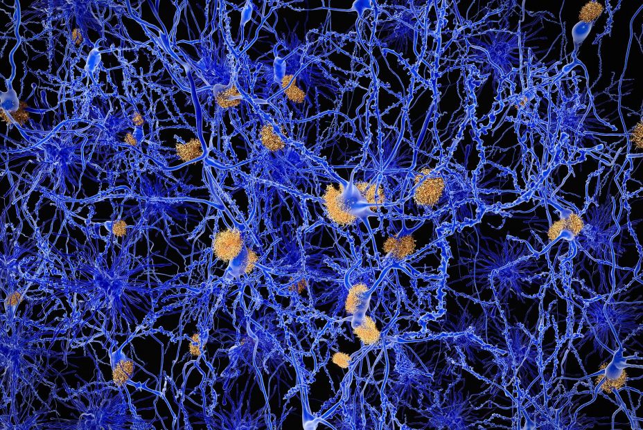 bigstock Alzheimer disease neurons wit 103463741