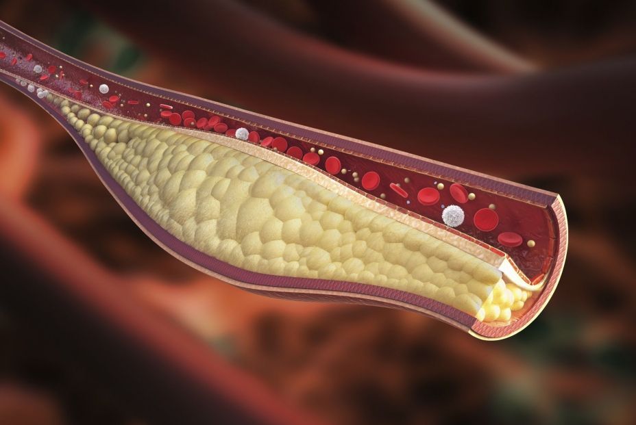 Descubren que una técnica de imagen podría ayudar a tratar la aterosclerosis