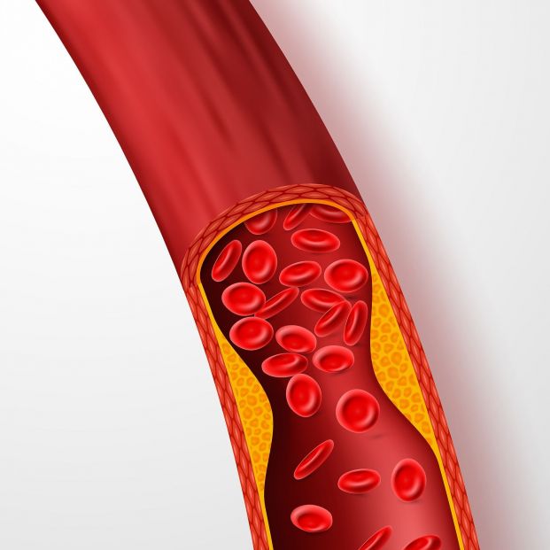 bigstock blocked blood vessel artery w 253491925