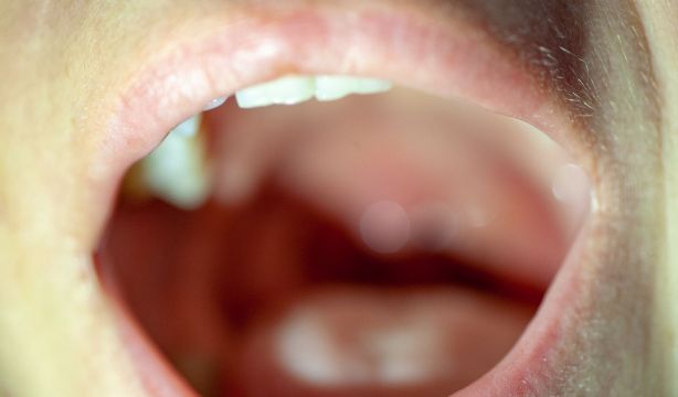 Cáncer de garganta: síntomas, causas y tratamiento. (Bigstock)