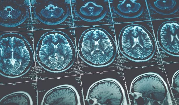 Unas células del sistema inmune predisponen a alzhéimer y tumores cerebrales a partir de los 57 años