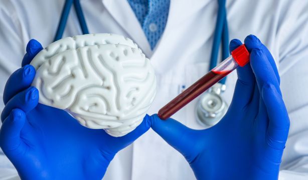 Un estudio confirma el uso de un biomarcador en sangre para detectar alzhéimer en fases iniciales