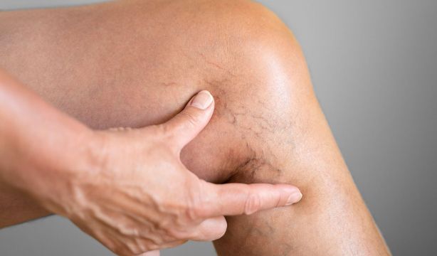 Un experto advierte de que las varices duplican el riesgo de insuficiencia cardíaca