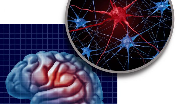 Observan por primera vez el desencadenante del párkinson en el tejido cerebral(Bigstock)