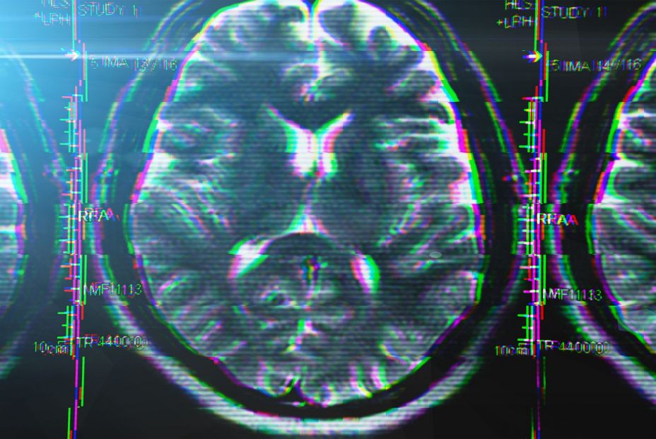 bigstock X ray Or Mri Brain Scan With G 233511862 (1)