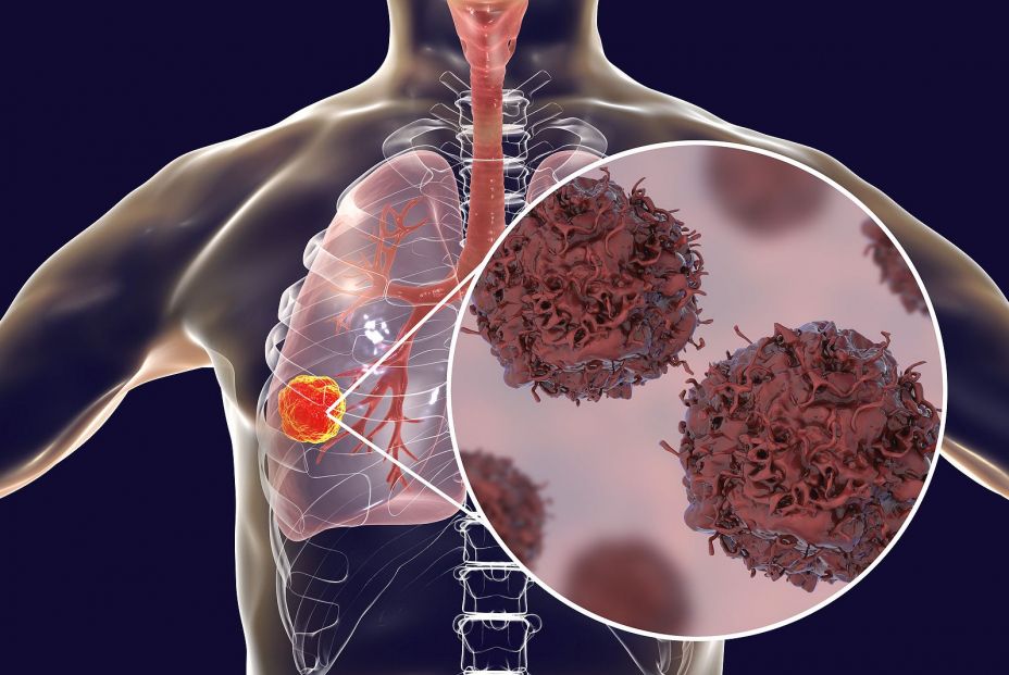 bigstock Lung Cancer Tumor Inside Lung 234773803