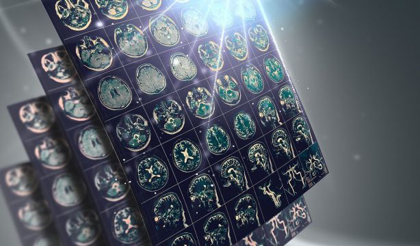 Así se pueden prevenir hasta un 90% de los ictus. (Bigstock)