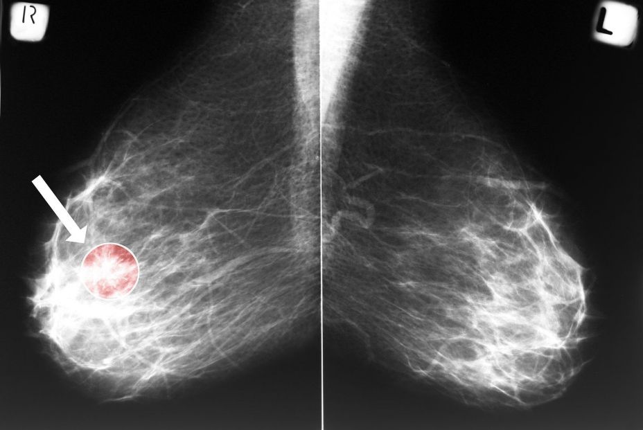 Una mamografía con cáncer de mama- (Bigstock)