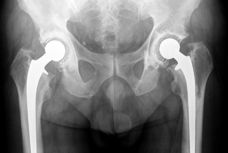 Imagen de una prótesis de cadera. (Bigstock)