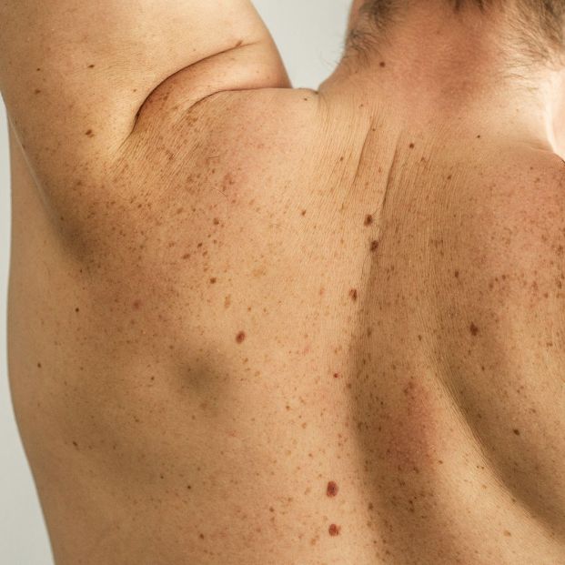 qué sabes de tus lunares