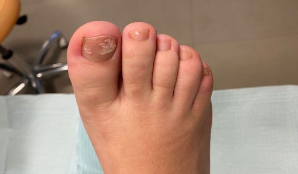  Sulfuro de hidrógeno: el gas con olor a huevo podrido que podría curar infecciones de uñas. Foto: Europa Press.