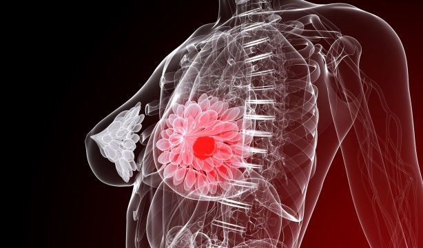 La IA ayuda a tener una visión "más completa" del cáncer de mama metastásico
