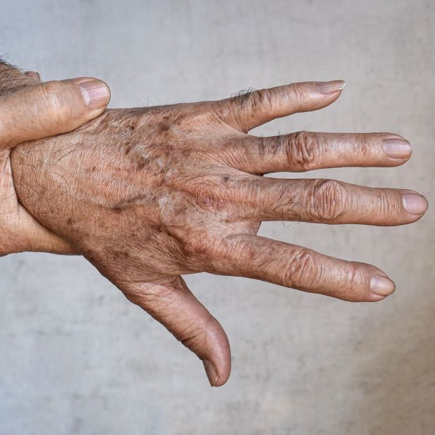 Manchas solares: un 90% de los mayores las presenta y ya tienen solución. Fuente: bigstock. Manchas solares: un 90% de los mayores las presenta y ya tienen solución. Fuente: bigstock.