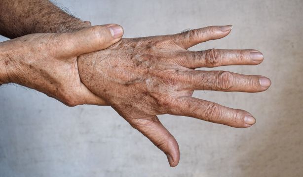 Manchas solares: un 90% de los mayores las presenta y ya tienen solución. Fuente: bigstock.