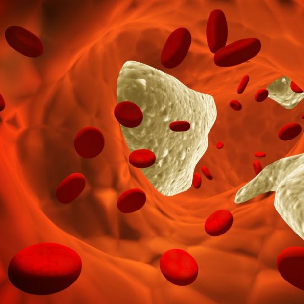 Aterosclerosis Aterosclerosis