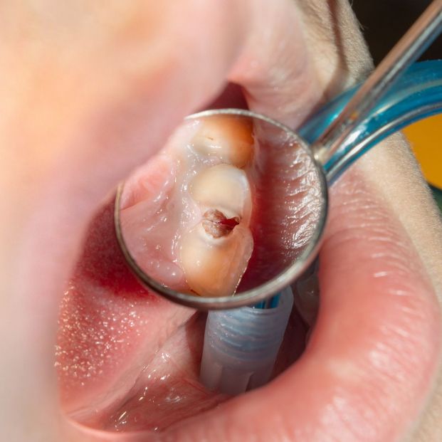 ¿Por qué me puede salir un doloroso flemón? Primeros auxilios antes de acudir al dentista ¿Por qué me puede salir un doloroso flemón? Primeros auxilios antes de acudir al dentista