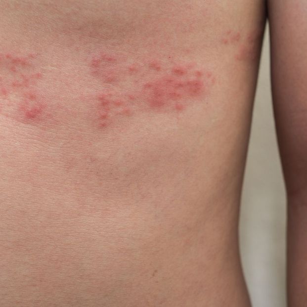 Herpes zoster, comúnmente llamada culebrilla Herpes zoster, comúnmente llamada culebrilla