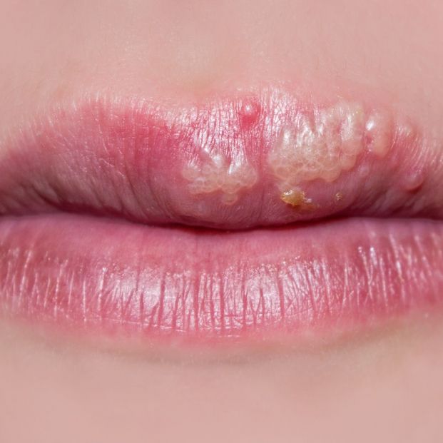 Herpes en labios