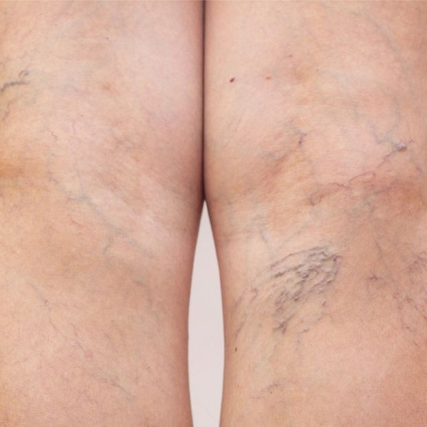 Un trombo formado en las venas de las extremidades inferiores puede migrar hasta las arterias pulmonares Un trombo formado en las venas de las extremidades inferiores puede migrar hasta las arterias pulmonares