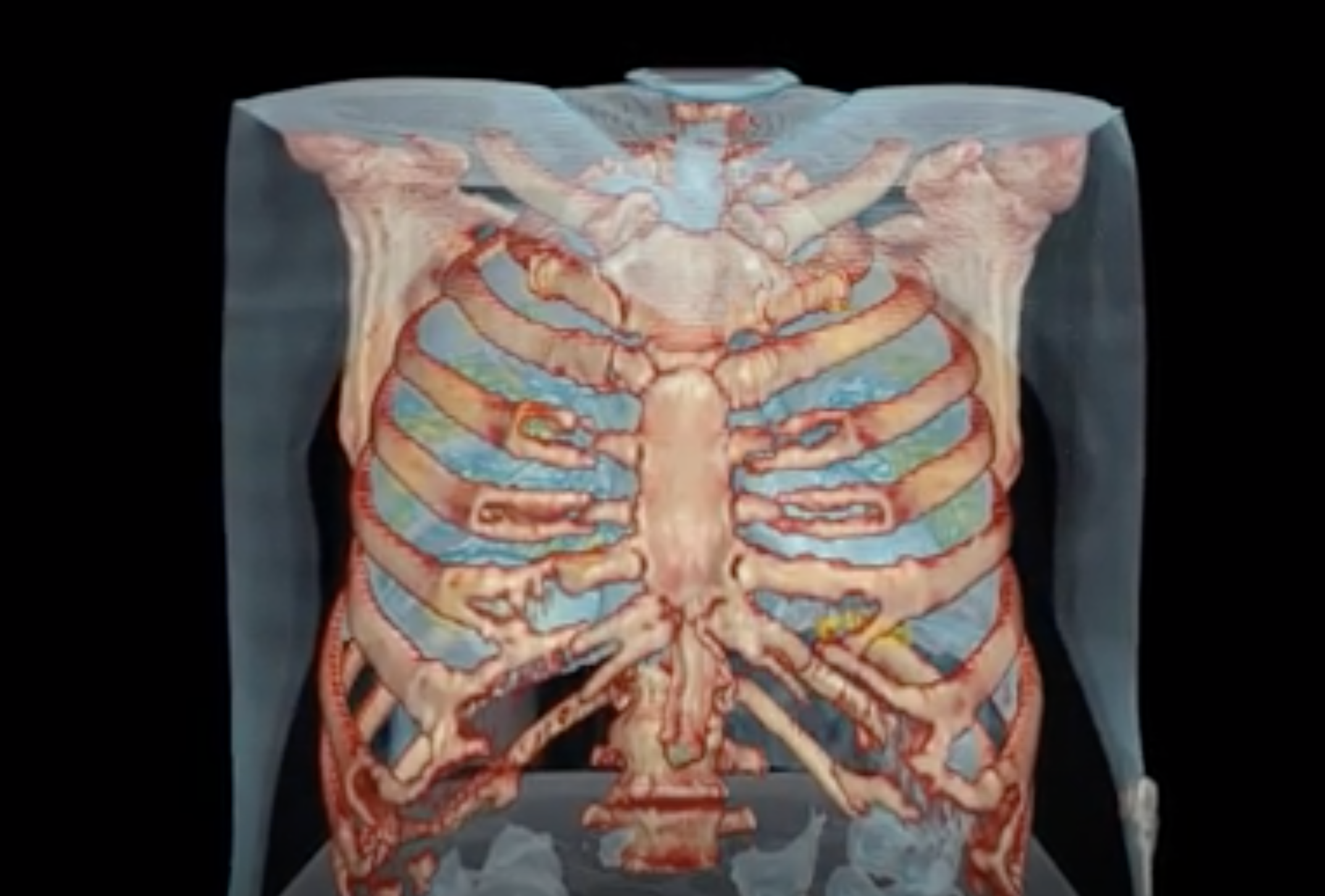 El impactante vídeo que muestra cómo ataca el coronavirus a los pulmones