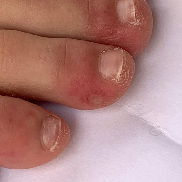 covid en pies covid en pies