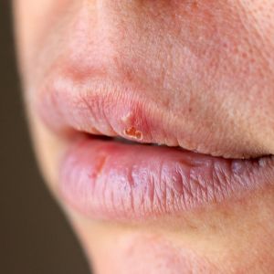 bigstock Herpes On The Lip Close Up Mac 270625021 bigstock Herpes On The Lip Close Up Mac 270625021