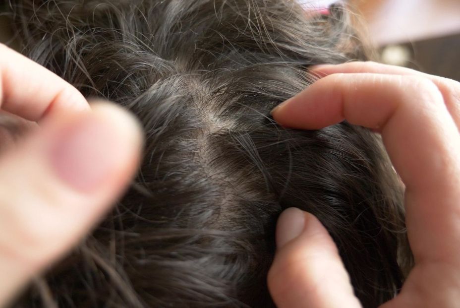 Mitos y verdades sobre los piojos Mitos y verdades sobre los piojos